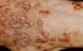 結節性痒疹 大森の大木皮膚科 治りにくい痒疹でお困りなら