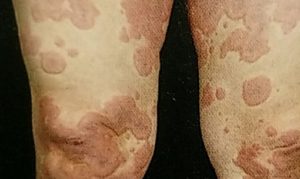 じんましん｜大森・大木皮膚科【蕁麻疹でお困りなら】