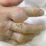 やけど（熱傷）｜大森・大木皮膚科【熱傷専門医が対応致します】