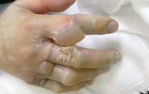 やけど（熱傷）｜大森・大木皮膚科【熱傷専門医が対応致します】