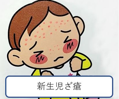 新生児ざ瘡