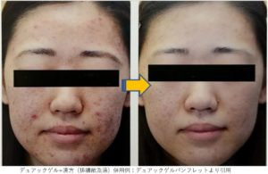 ニキビ治療のお薬｜大森・大木皮膚科【外用剤と内服を詳しく解説】