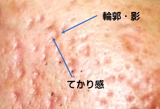 ニキビ跡 大森の大木皮膚科 ざ瘡瘢痕の予防は早期の治療です