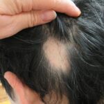 円形脱毛症｜大田区大森・大木皮膚科【原因･予後と治療を詳しく解説】