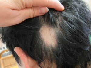 円形脱毛症｜大田区大森・大木皮膚科【原因･予後と治療を詳しく解説】