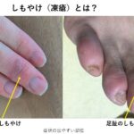 しもやけ(凍瘡)|大森・大木皮膚科【皮膚科での治し方は?】