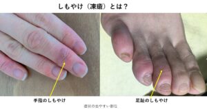 しもやけ（凍瘡）｜大森・大木皮膚科【皮膚科での治し方は？】