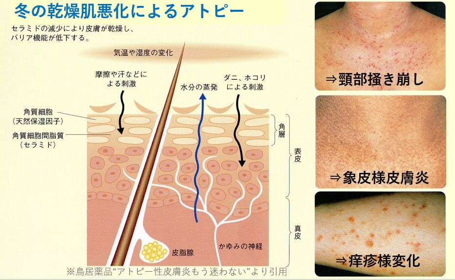湿疹とは何ですか？