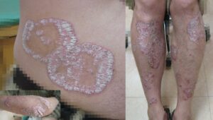 乾癬｜大田区大森・大木皮膚科【原因と治療薬・治し方を詳しく解説】