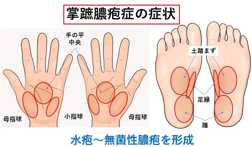 汗疱 掌蹠膿疱症の原因と治し方 - 健康/医学