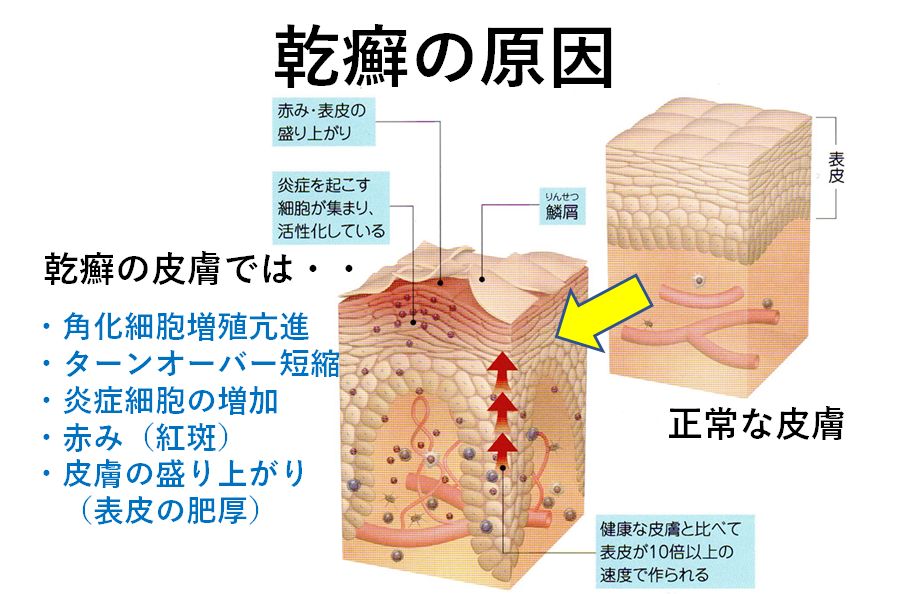 頭皮乾癬の治療法