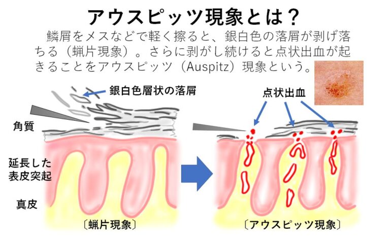 乾癬｜大田区大森・大木皮膚科【原因と治療薬・治し方を詳しく解説】