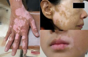 白斑｜大田区大森・大木皮膚科【原因と治し方・白斑治療を詳しく解説】