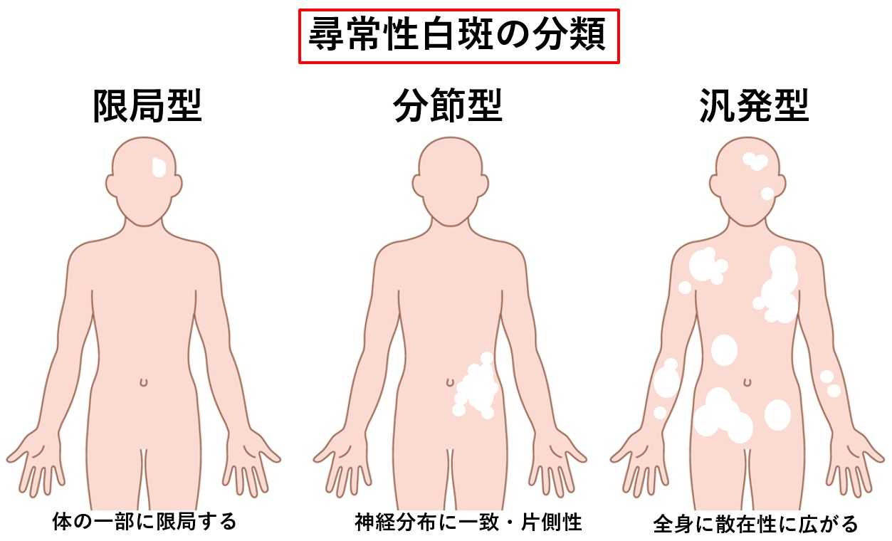 白斑 大田区大森 大木皮膚科 原因と治し方 白斑治療を詳しく解説