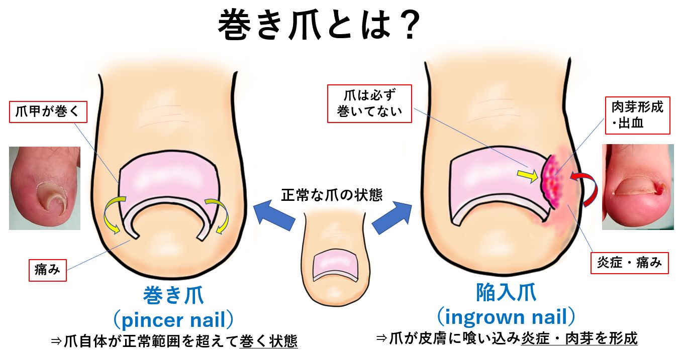 巻き爪と陥入爪でお困りなら｜大田区大森・大木皮膚科【巻き爪治療