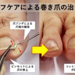 陥入爪と巻き爪の違い・見分け方｜大田区大森の大木皮膚科
