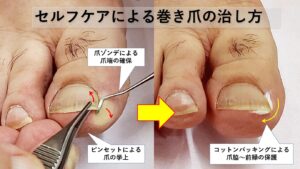 巻き爪治し方・自分でコットン治ったセルフケア法|大田区大森の大木皮膚科