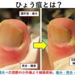 巻き爪治療・病院でのおすすめ保険適用治療｜大田区大森･大木皮膚科