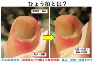 ひょう疽・爪周囲炎｜大田区大森・大木皮膚科/指の化膿でお困りなら