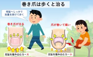 巻き爪は歩くと治る・正しい歩き方は？｜大田区大森・大木皮膚科