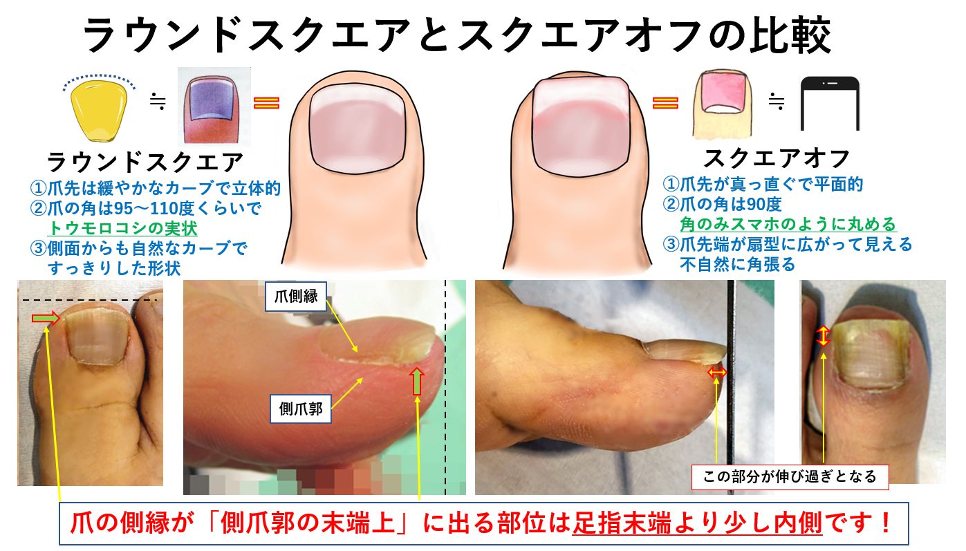 巻き爪切り方・ニッパー使い方を画像で解説｜大田区大森・大木皮膚科