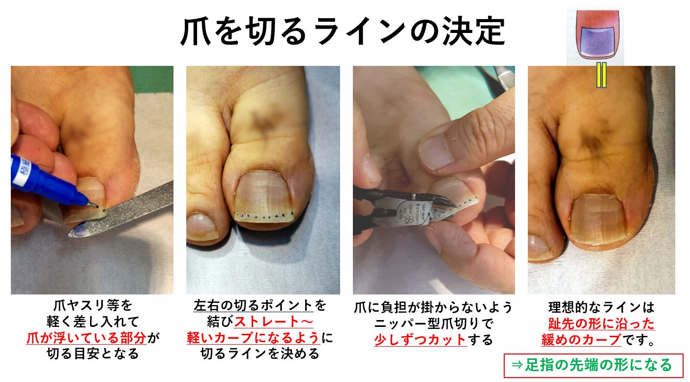 巻き爪切り方・ニッパー使い方を画像で解説｜大田区大森・大木皮膚科