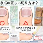 陥入爪と巻き爪の違い・見分け方｜大田区大森の大木皮膚科
