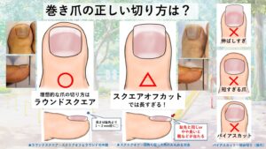 巻き爪切り方・ニッパー使い方を画像で解説｜大田区大森・大木皮膚科