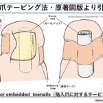 陥入爪と巻き爪の違い・見分け方｜大田区大森の大木皮膚科