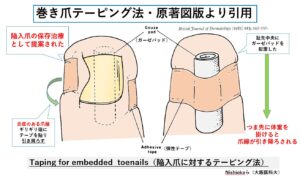 巻き爪テーピングは治る?効果を詳しく解説|大田区大森・大木皮膚科