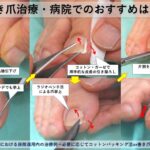 巻き爪治療費用・相場いくらか詳しく解説｜大田区大森大木皮膚科