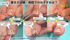 巻き爪治療・病院でのおすすめ保険適用治療｜大田区大森･大木皮膚科