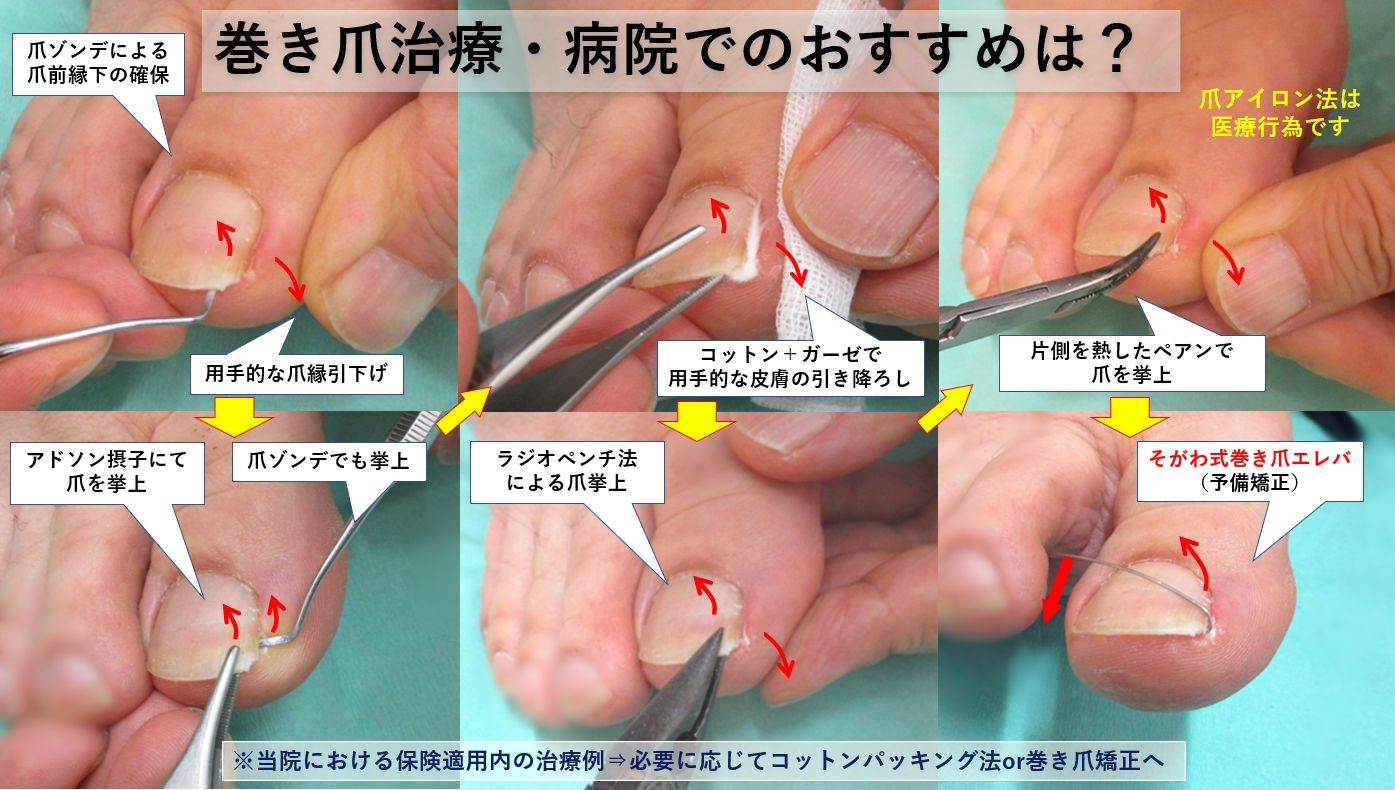 最安挑戦！ 痛くない巻き爪補正の技術セミナーなら【ペディグラス