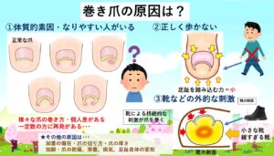巻き爪原因・足の巻き爪になりやすい人は？｜大田区大森･大木皮膚科