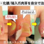 陥入爪と巻き爪の違い・見分け方｜大田区大森の大木皮膚科