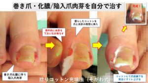 巻き爪化膿・陥入爪肉芽を自分で治すには？｜大田区大森･大木皮膚科