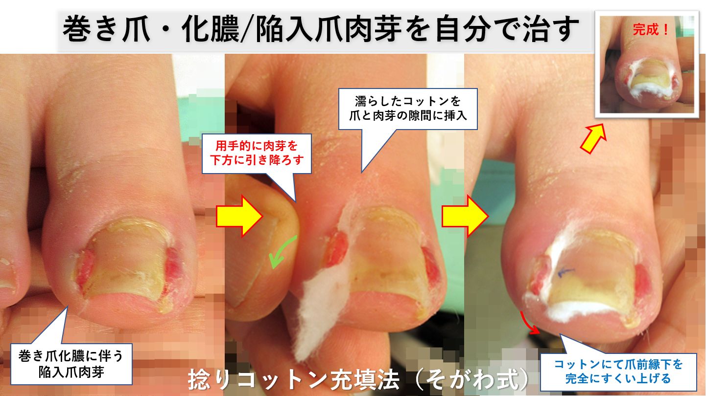 テリーの爪の原因は何ですか?