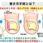 巻き爪治療費用・相場いくらか詳しく解説｜大田区大森大木皮膚科