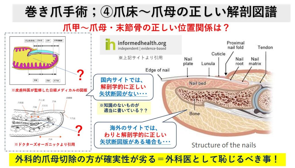 巻き爪手術痛い?手術方法や後遺症につき詳しく解説|大田区大森・大木皮膚科