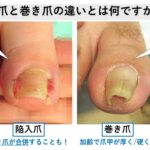 巻き爪テーピングは治る？効果を詳しく解説｜大田区大森･大木皮膚科
