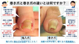 陥入爪と巻き爪の違い・見分け方｜大田区大森の大木皮膚科