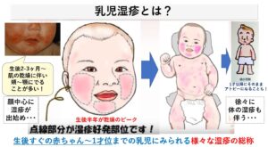 乳児湿疹の小児皮膚科・赤ちゃん肌トラブル｜大田区大森の大木皮膚科