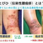 とびひ /伝染性膿痂疹とは？原因と治し方｜大田区大森の大木皮膚科