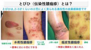 とびひ /伝染性膿痂疹とは？原因と治し方｜大田区大森の大木皮膚科
