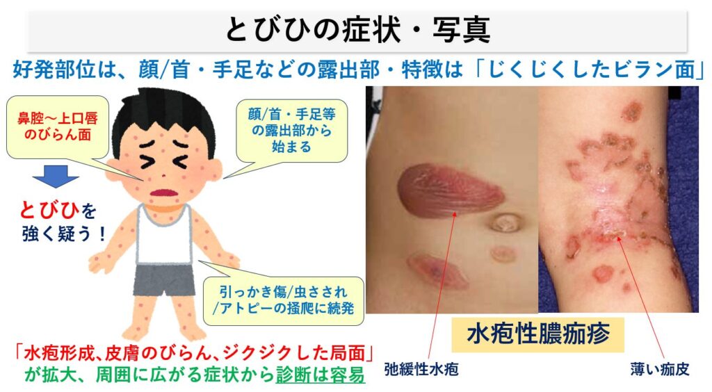 とびひ /伝染性膿痂疹とは？原因と治し方｜大田区大森の大木皮膚科