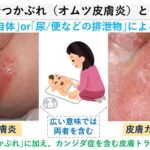 おむつかぶれ（おむつ皮膚炎）のお薬と治し方｜大田区大森の大木皮膚科
