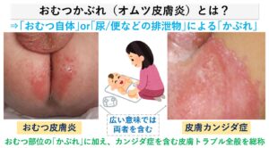おむつかぶれ（おむつ皮膚炎）のお薬と治し方｜大田区大森の大木皮膚科