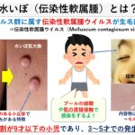 水いぼ（伝染性軟属腫）お薬と治し方｜大田区大森の大木皮膚科　　　　