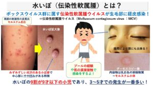 水いぼ（伝染性軟属腫）お薬と治し方｜大田区大森の大木皮膚科　　　　